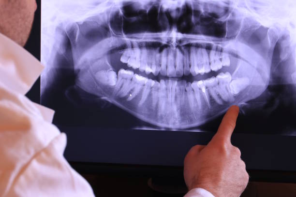 Best Emergency Wisdom Teeth Removal in Jefferson, LA